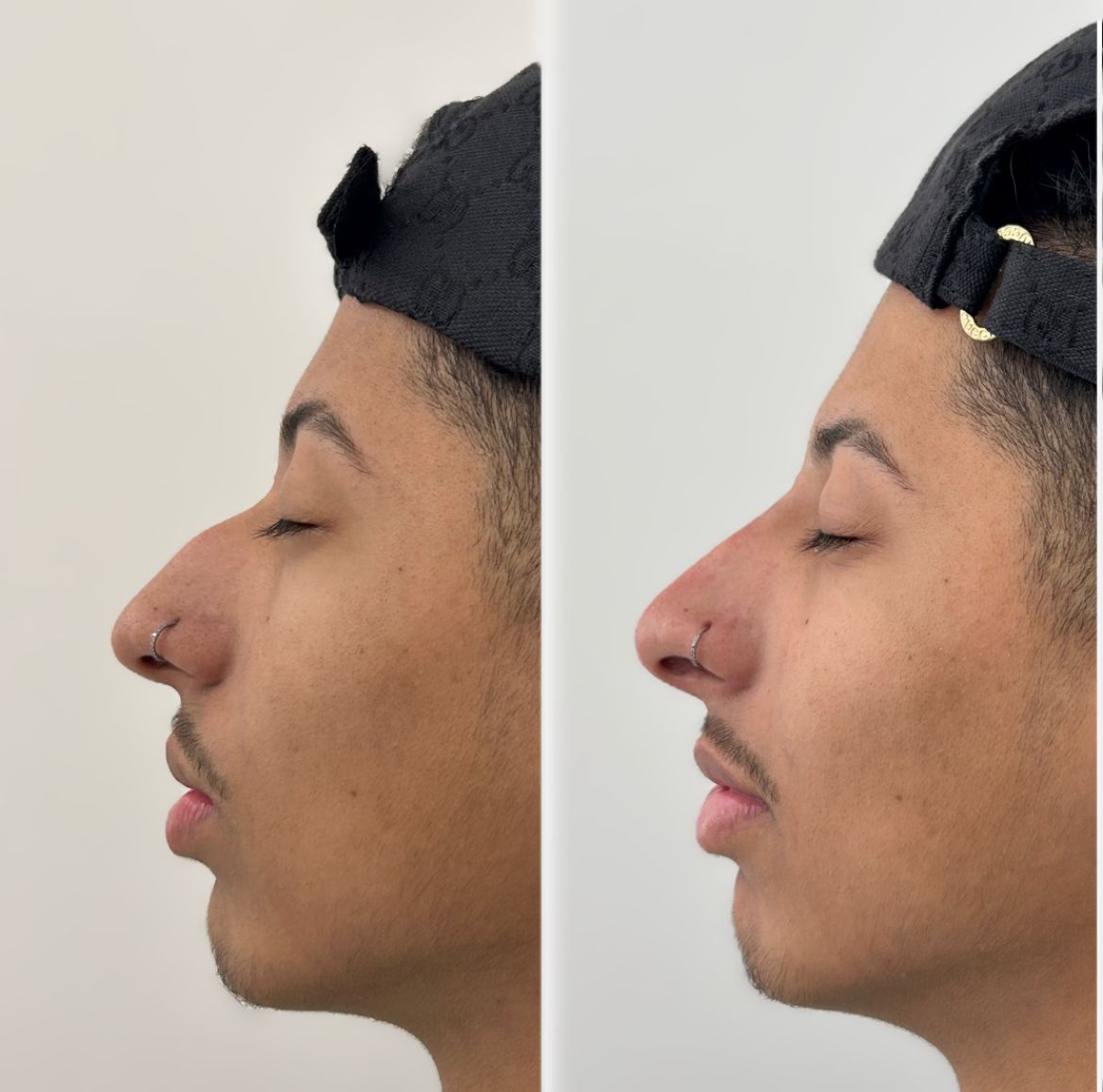 Antes e depois — Rinomodelação
